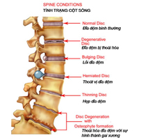 Stages of Disc degeneration